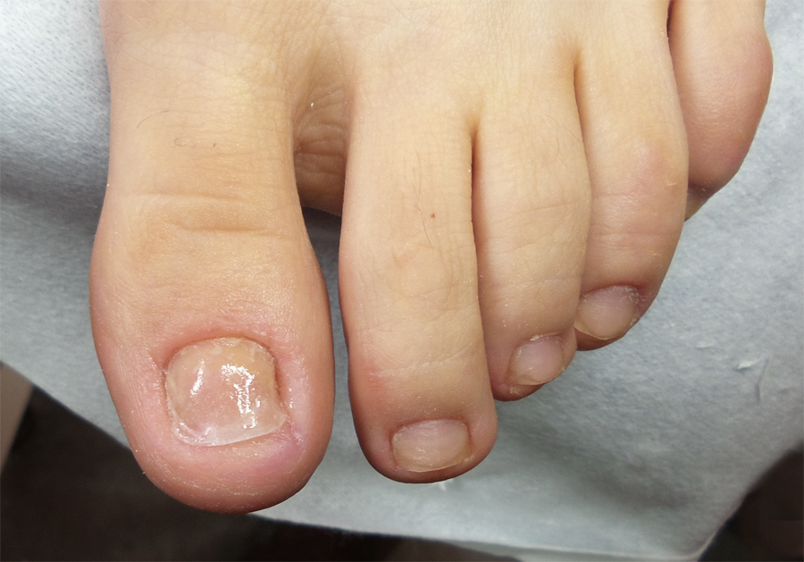 Признаки грибковой инфекции ногтей и кожи стоп