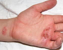 hand-eczema